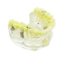 歯科透明インプラントモデル模型 歯科治療説明用虫歯付きの上顎模型 脱着可能