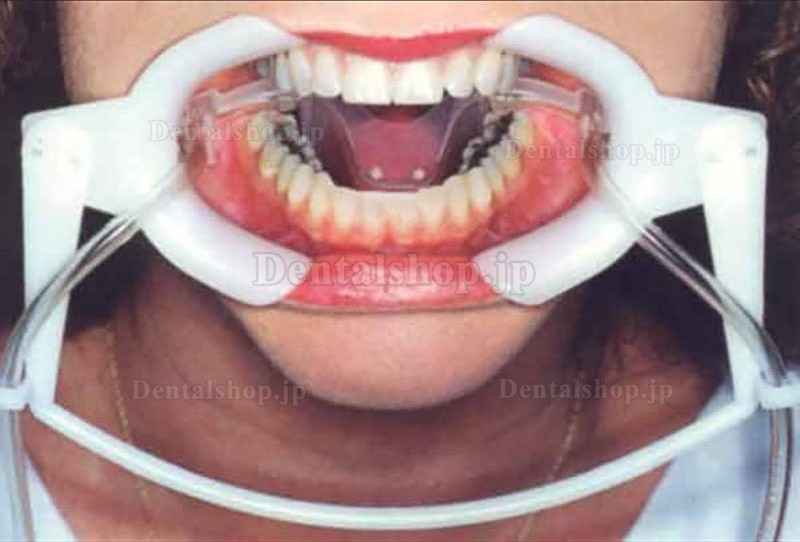 1個歯科用開口器 唾液吸引チューブ付き (マウスオープナー・口角鈎)
