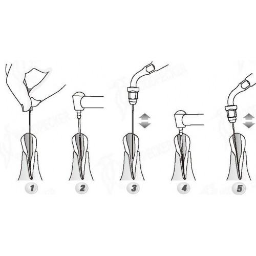 Woodpecker®根管治療用チップED1（SATELECと交換、5本入）