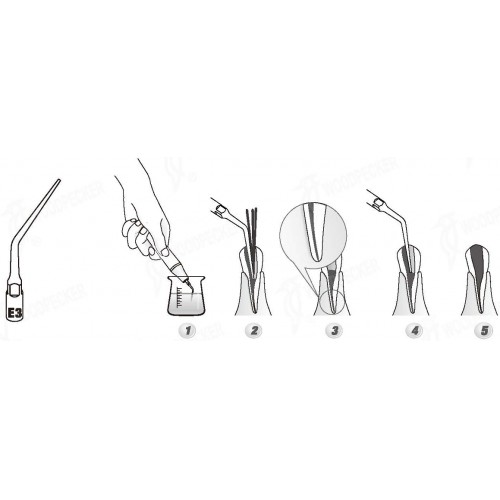 Woodpecker®根管治療用チップED3（DTE/SATELECと交換、5本入）