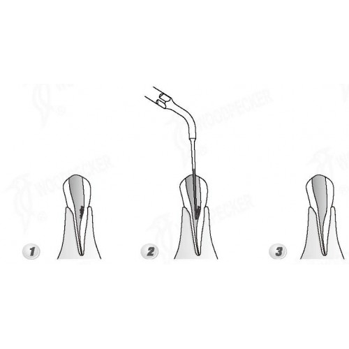 Woodpecker®DTE根管治療用チップED4D（SATELECと交換、5本入）