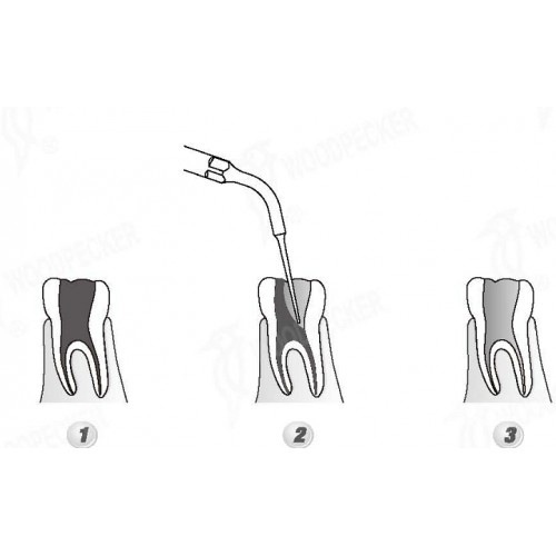 Woodpecker®DTE根管治療用チップED5（SATELECと交換、5本入）