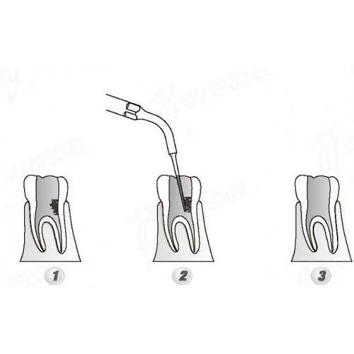 Woodpecker®DTE根管治療用チップED5D（SATELECと交換、5本入）