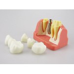 JX®M2017歯科インプラント・クラウン歯模型