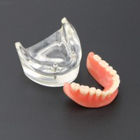 歯科モデル下顎重塁義歯 2本インプラント教学用模型6002 01