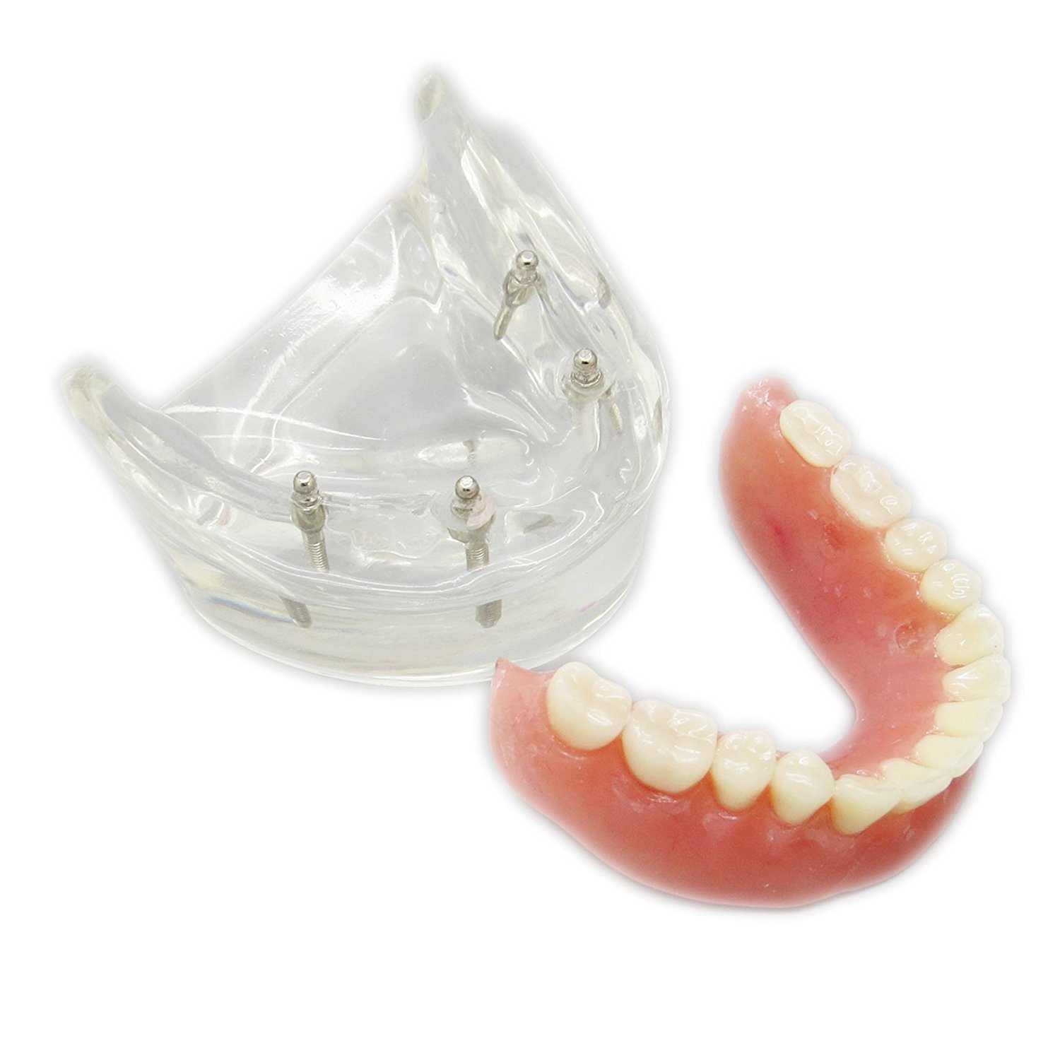 歯科下顎インプラント用義歯モデル模型 研究治療説明用歯科模型 4本インプラント脱着可能 クリアベース 透明通販-Dentalshop.JP