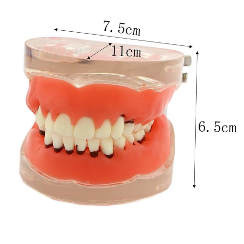 歯科上下顎歯周萎縮模型 開閉式歯結石模型 歯科研究治療説明用歯列疾患モデル クリアベース