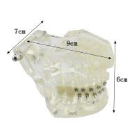 高品質歯列矯正治療説明用 ブラケットモデル セラミックメタル上下顎 模型 クリアベース