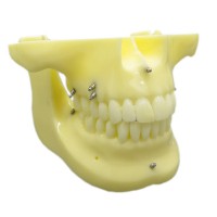 歯科矯正用上下顎歯列模型モデル インプラントモデル スクリューアンカー付き 脱着可能 イエローベース