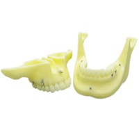 歯科矯正用上下顎歯列模型モデル インプラントモデル スクリューアンカー付き 脱着可能 イエローベース