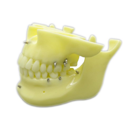 歯科矯正用上下顎歯列模型モデル インプラントモデル スクリューアンカー付き 脱着可能 イエローベース