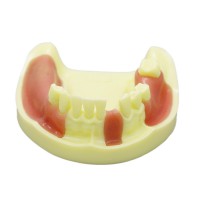 歯科下顎義歯模型 インプラント研究練習用道具 標準教学道具 イエローベース
