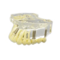 歯科上顎模型インプラントモデル模型 歯列研究用治療説明用教学模型 脱着可能 4本インプラント クリアベース 透明