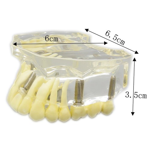 歯科上顎模型インプラントモデル模型 歯列研究用治療説明用教学模型 脱着可能 4本インプラント クリアベース 透明