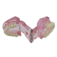 歯科上下顎治療説明用矯正模型 ブラケットモデル セラミック メタル ピンク