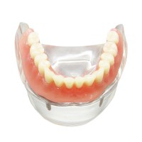 歯科下顎インプラント用義歯モデル模型 研究治療説明用歯科模型 4本インプラント脱着可能 クリアベース 透明