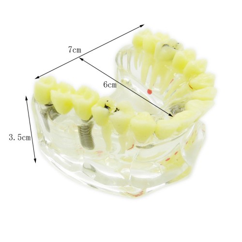 歯科透明インプラントモデル模型 歯科治療説明用虫歯付きの上顎模型 脱着可能