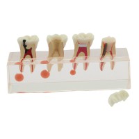 歯科虫歯拡大モデル 高品質透明虫歯歯髄炎治療説明用歯列模型