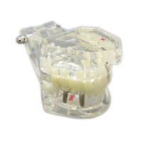 歯科上下顎180度開閉式インプラントモデル模型 虫歯治療説明用透明歯列模型
