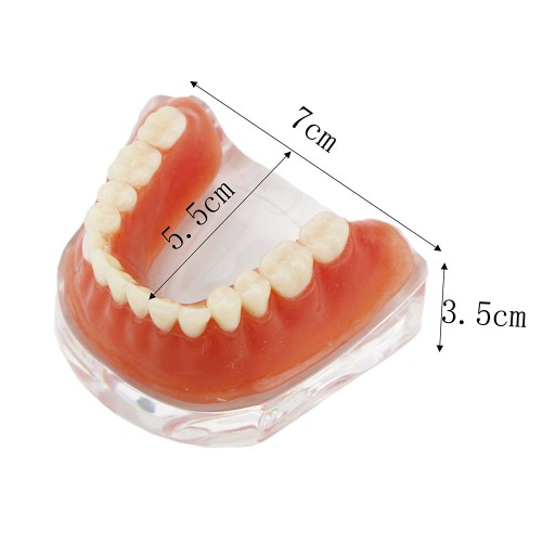 歯科下顎インプラントモデル模型 バーアタッチメント義歯模型 研究用治療説明歯列模型 クリアベース 4本インプラント