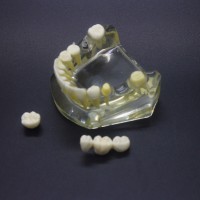 1:1 歯科下顎インプラントモデル インプラント、ブリッジ付き2010