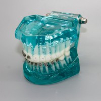 歯科矯正治療モデル金属セラミック舌側ブラケット付き3009