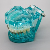 歯科矯正治療モデル金属セラミック舌側ブラケット付き3009