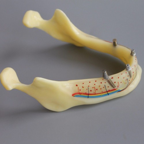 歯科模型＃2014 02 - 下顎インプラントとオーバーデンチャーモデル（黄色）