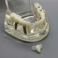 歯科インプラント研究分析用モデル 歯科疾患と回復モデル