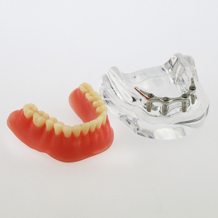 ○歯科用 部分床義歯ノンメタルクラスプ義歯デモ用模型
