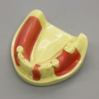歯科模型 モデル 下顎インプラント練習モデル 歯肉付き #2004 01