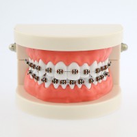 歯科モデル 歯列矯正 模型 研究教学用モデル ブレース付き 5006