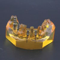 歯科用模型 インプラント 歯科モデル 上顎 デモモデル＃201102