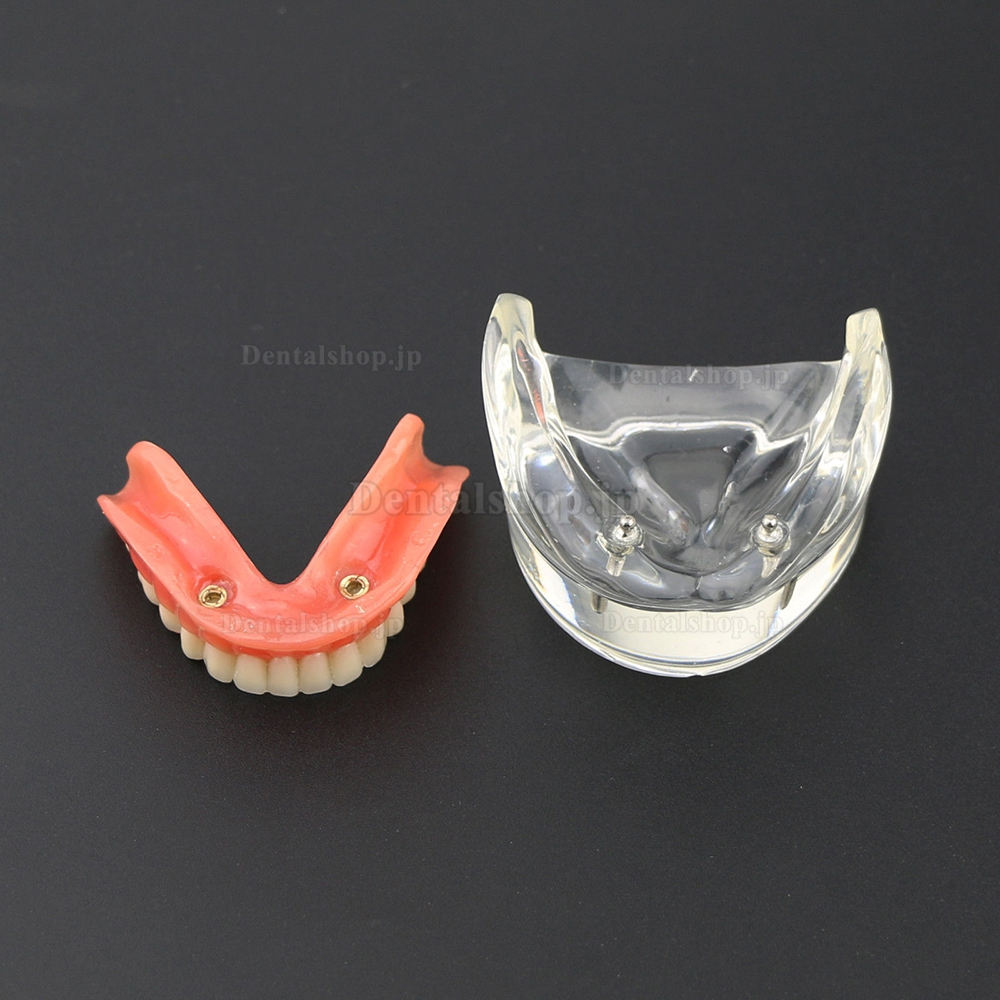 歯科モデル下顎重塁義歯 2本インプラント教学用模型6002 01