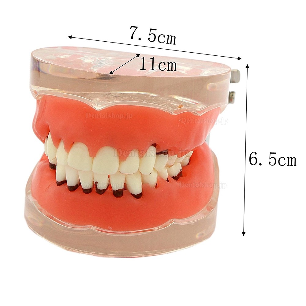 歯科上下顎歯周萎縮模型 開閉式歯結石模型 歯科研究治療説明用歯列疾患モデル クリアベース