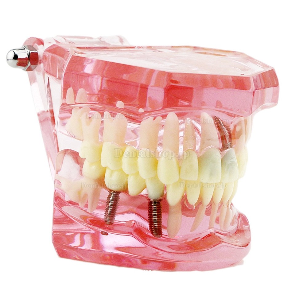 歯科上下顎180度開閉式インプラント歯列モデル模型 歯の構造虫歯研究治療用模型 ピンク