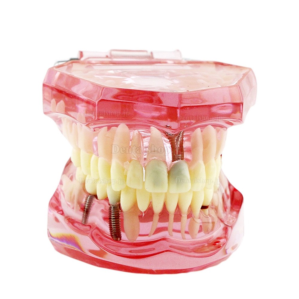 歯科上下顎180度開閉式インプラント歯列モデル模型 歯の構造虫歯研究治療用模型 ピンク
