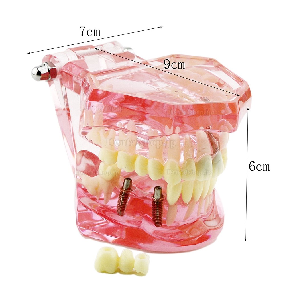 歯科上下顎180度開閉式インプラント歯列モデル模型 歯の構造虫歯研究治療用模型 ピンク