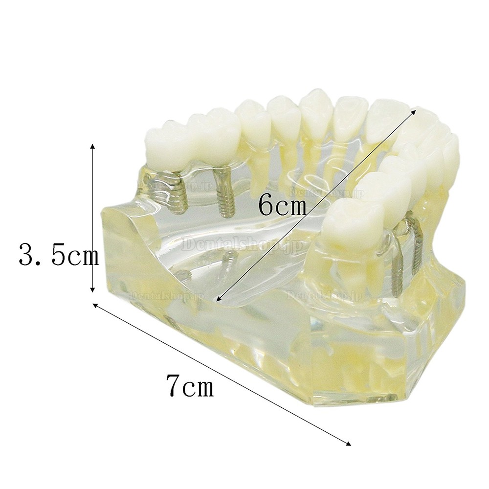 歯科インプラント治療説明用上顎模型モデル 4本インプラント 脱着可能 クリアベース 透明