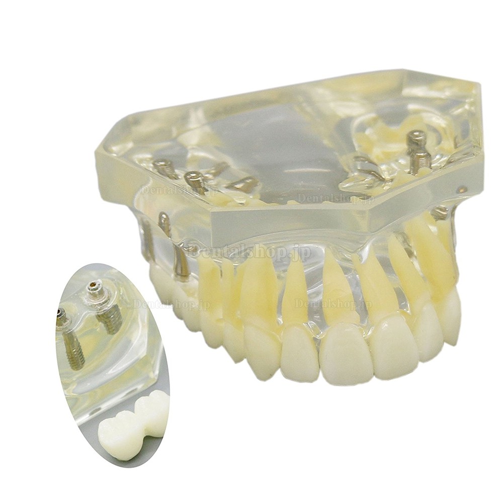 歯科インプラント治療説明用上顎模型モデル 4本インプラント 脱着可能 クリアベース 透明