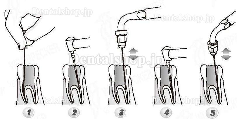 Woodpecker®根管治療用チップED2（SATELECと互換、5本入）