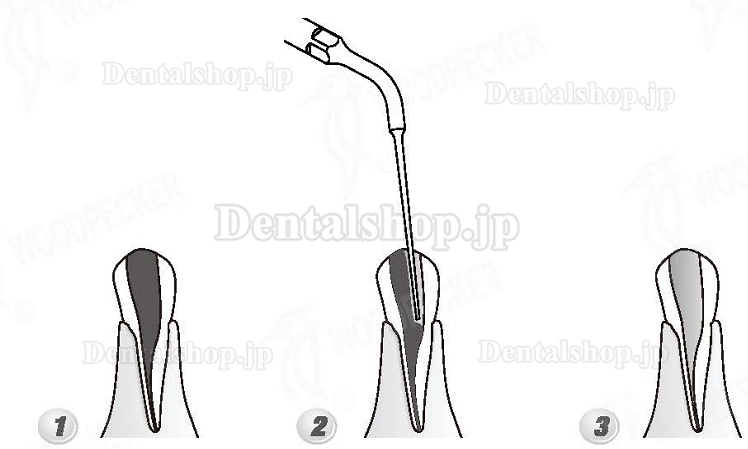 Woodpecker®DTE根管治療用チップED4（SATELECと交換、5本入）