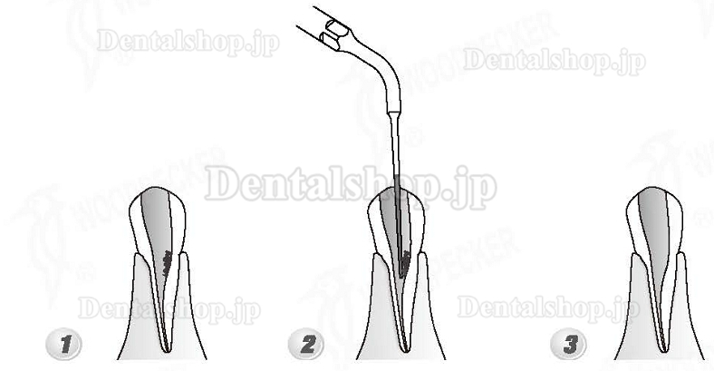 Woodpecker®DTE根管治療用チップED4D（SATELECと交換、5本入）