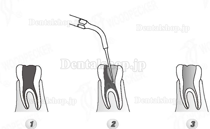 Woodpecker®DTE根管治療用チップED5（SATELECと交換、5本入）