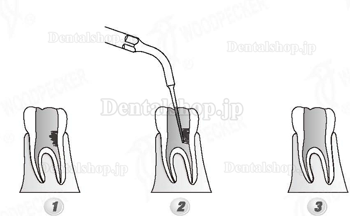 Woodpecker®DTE根管治療用チップED5D（SATELECと交換、5本入）