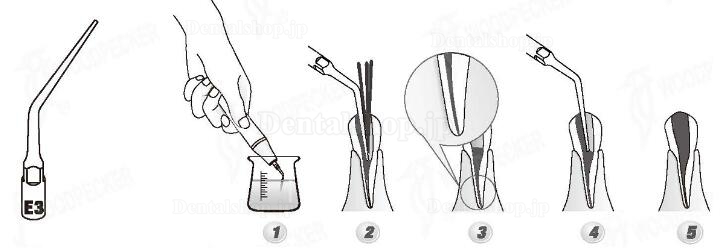 Woodpecker® ED3 DTE根管治療用チップ(SATELEC、NSKと交換、5本入)