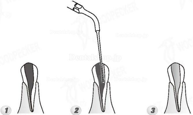 Woodpecker® ED4 DTE根管治療用チップ(SATELEC、NSKと交換、5本入)