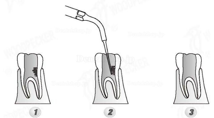 Woodpecker® ED5D DTE根管治療用チップ(SATELEC、NSKと交換、5本入)