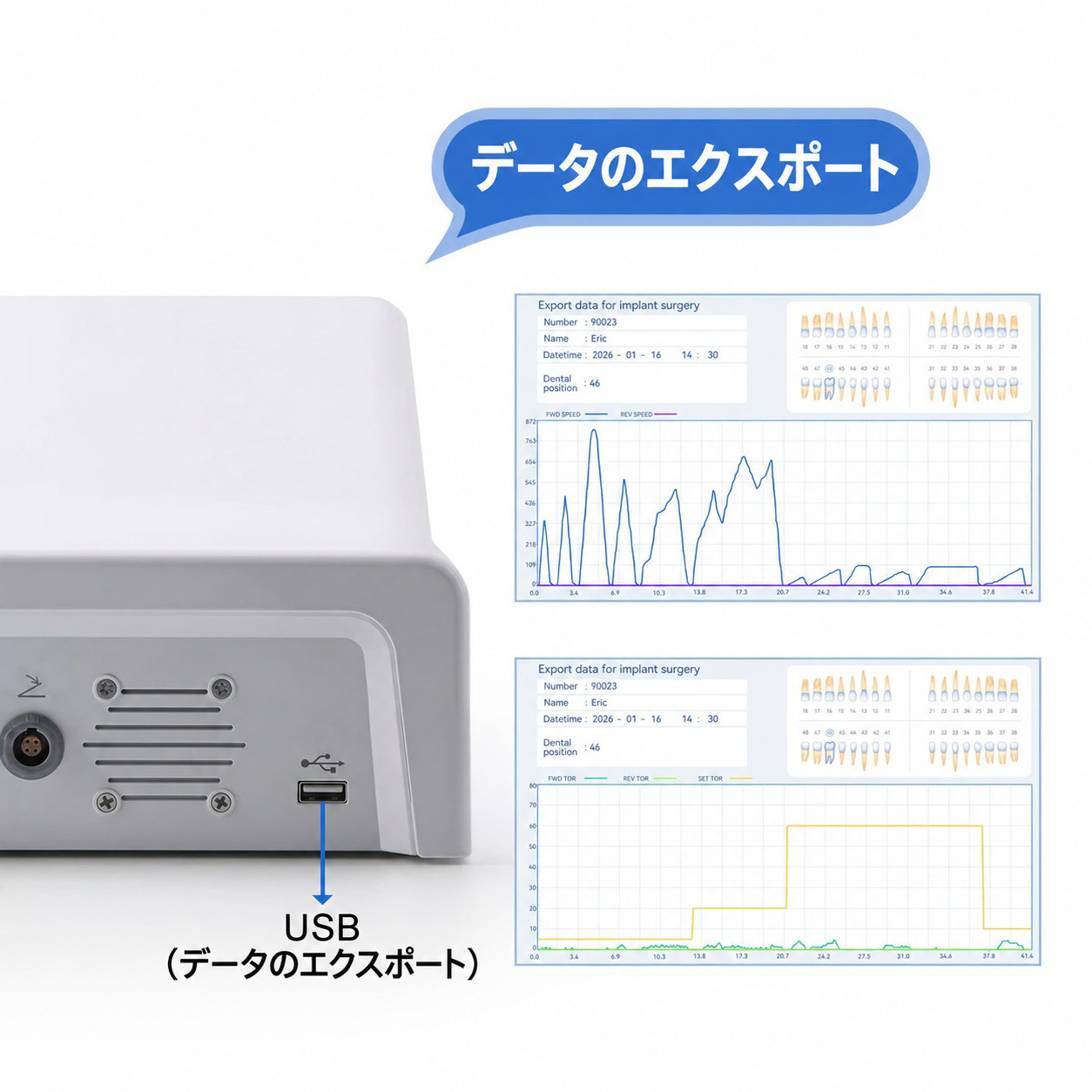 Betterway Surgic G3 歯科用インプラント手術用モーターシステム + 20:1 コントラアングル Betterway Surgic G3 歯科用インプラント手術用モーターシステム + 20:1 コントラアングル