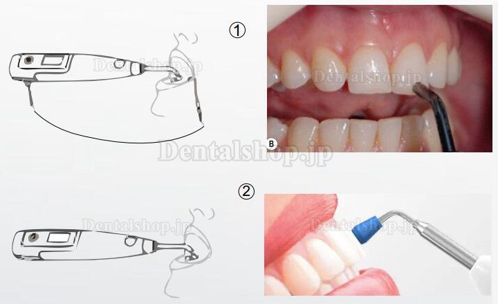 Denjoy MeteEndo 歯科根管治療統合システム(Meta Fill/Meta Pex/Meta Motor/Meta Pulp/Meta Pack付き)